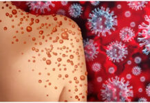 ಮಂಕಿಪಾಕ್ಸ್ ಆತಂಕ – ರಾಜ್ಯ ಆರೋಗ್ಯ ಇಲಾಖೆ ಫುಲ್ ಅಲರ್ಟ್ – ರಾಜ್ಯದ ವಿಮಾನ ನಿಲ್ದಾಣಗಳಲ್ಲಿ ಕಟ್ಟೆಚ್ಚರ ಕ್ರಮಕ್ಕೆ ಆದೇಶ